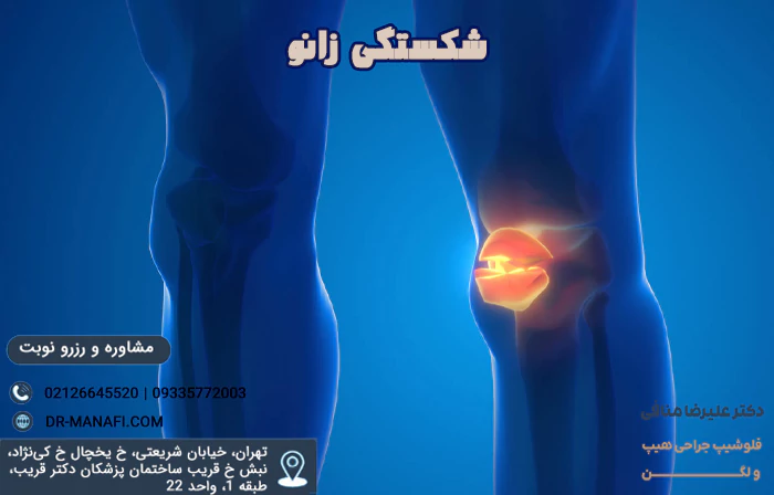 شکستگی زانو چیست