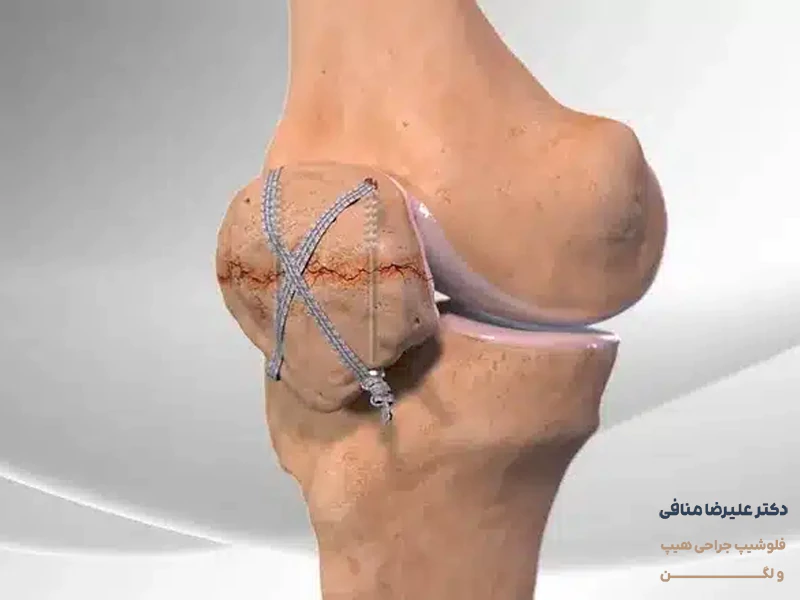 شکستگی زانو