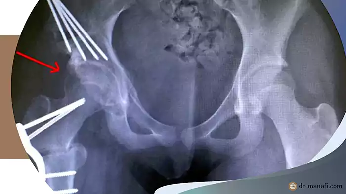 استئوتومی لگن چیست