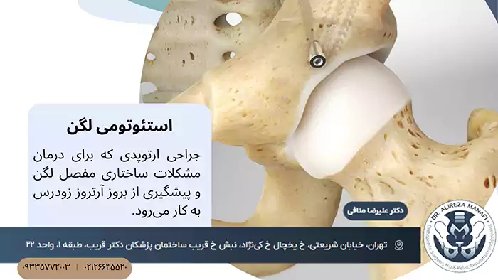 استئوتومی لگن