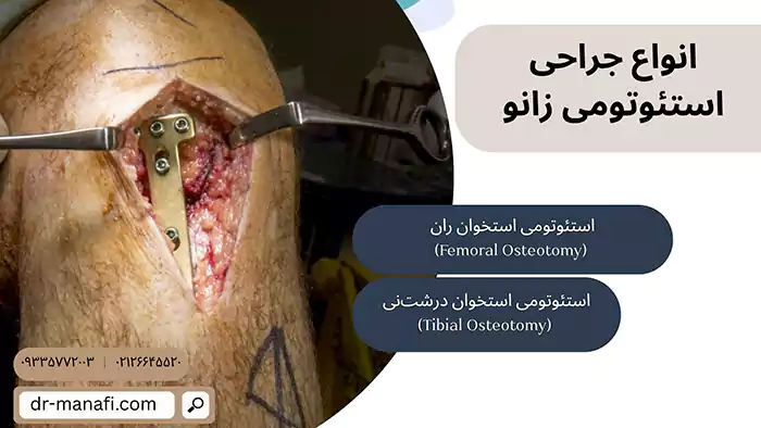 انواع جراحی استئوتومی زانو
