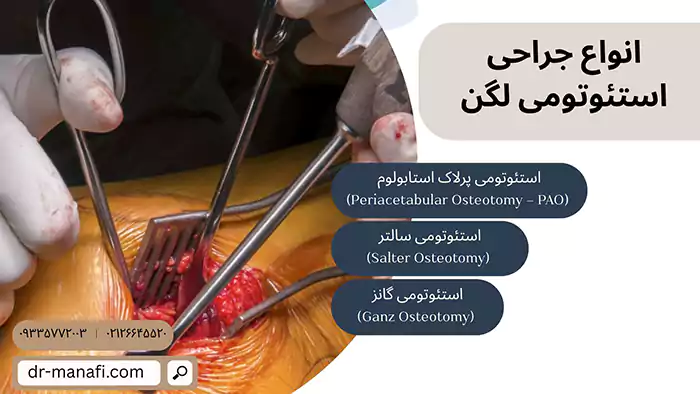 انواع جراحی استئوتومی لگن