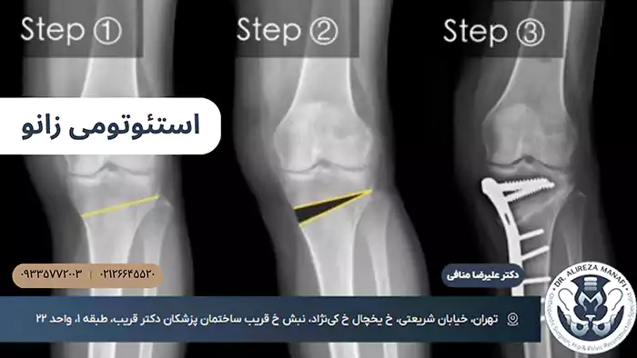 جراحی استئوتومی زانو