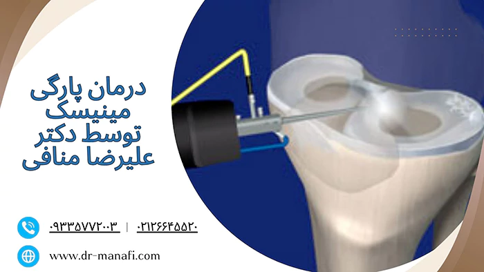 درمان پارگی مینیسک توسط دکتر منافی