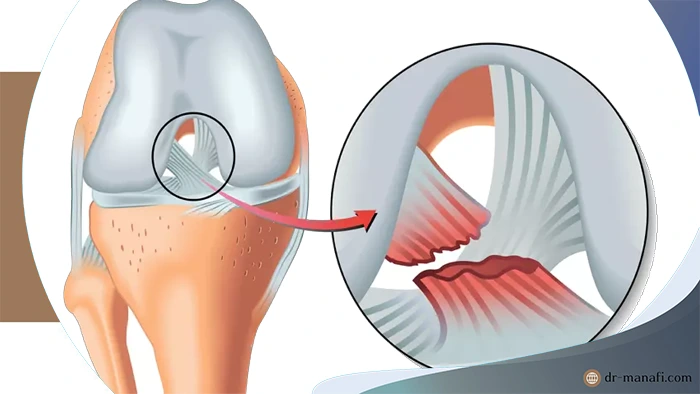 پارگی رباط صلیبی