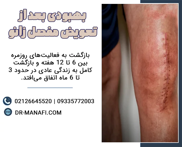 بهبودی بعد از تعویض مفصل زانو