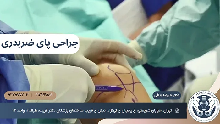 جراحی پای ضربدری یا ایکس