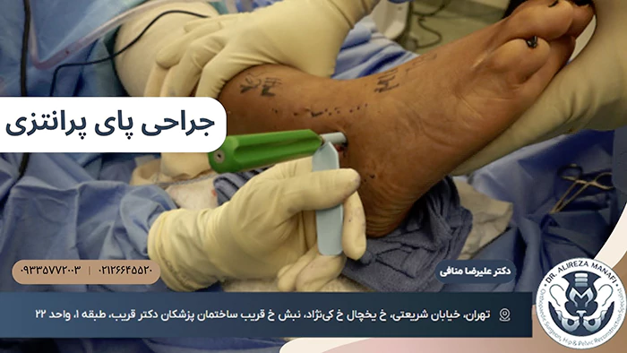 جراحی پای پرانتزی