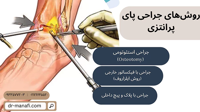 روش های جراحی پای پرانتزی