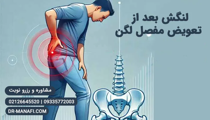 لنگش بعد از جراحی تعویض مفصل لگن