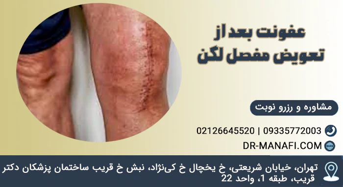 عفونت بعد تعویض مفصل لگن