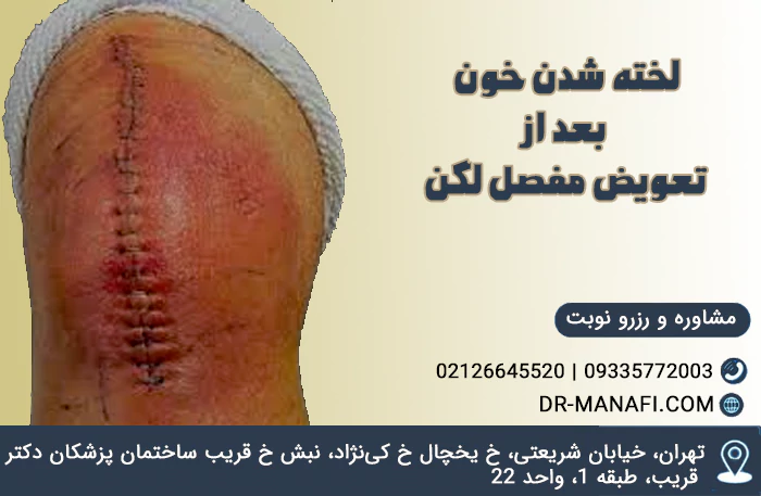 لختگی خون بعد از تعویض مفصل لگن