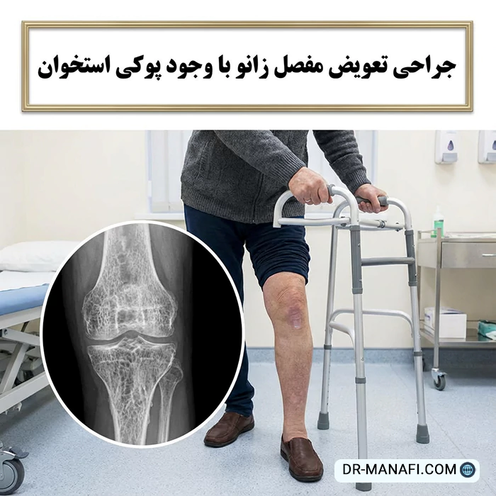 تعویض مفصل زانو با وجود پوکی استخوان