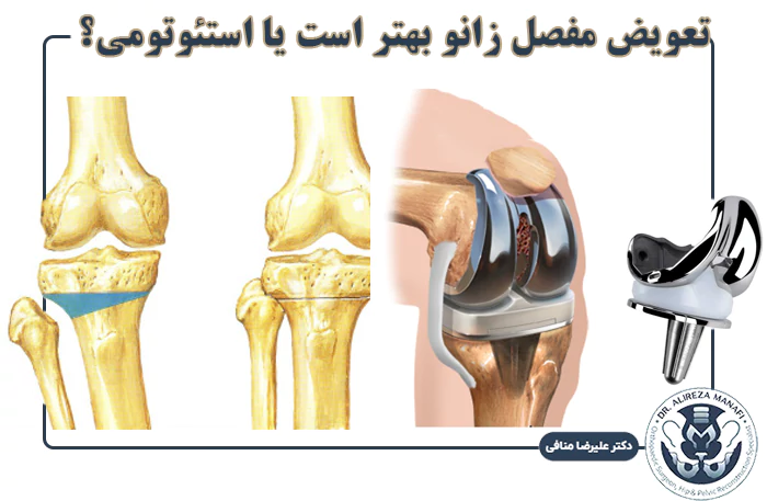 تعویض مفصل زانو بهتر است یا استئوتومی