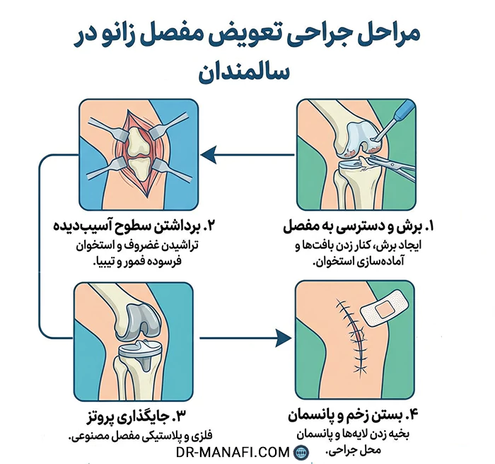 تعویض مفصل زانو در سالمندان
