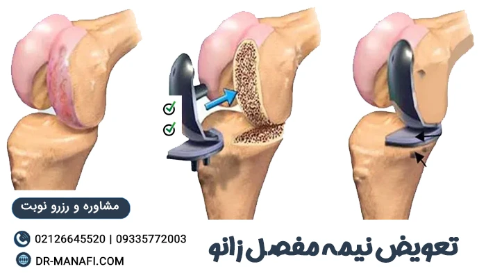 تعویض نیمه مفصل زانو
