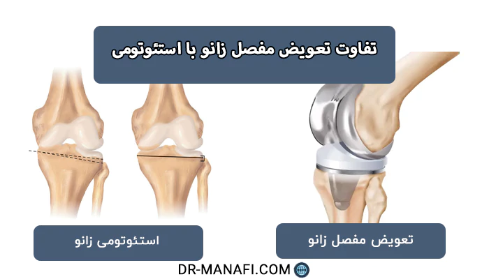 تفاوت تعویض مفصل زانو با استئوتومی