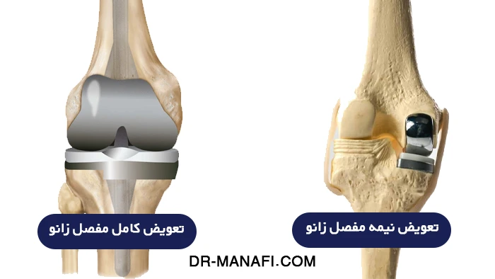 تفاوت تعویض نیمه مفصل زانو با تعویض کامل زانو